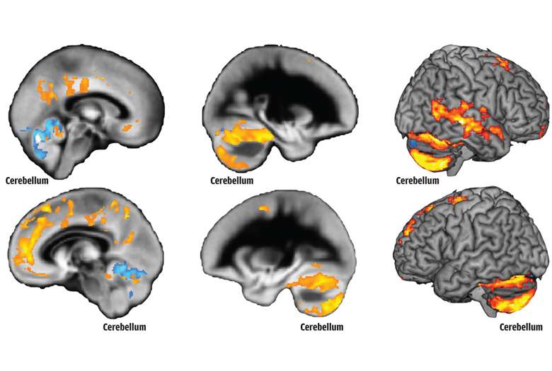 Composite brain scan images from the young people who took part in the study. Source: Neuroimage: Clinical